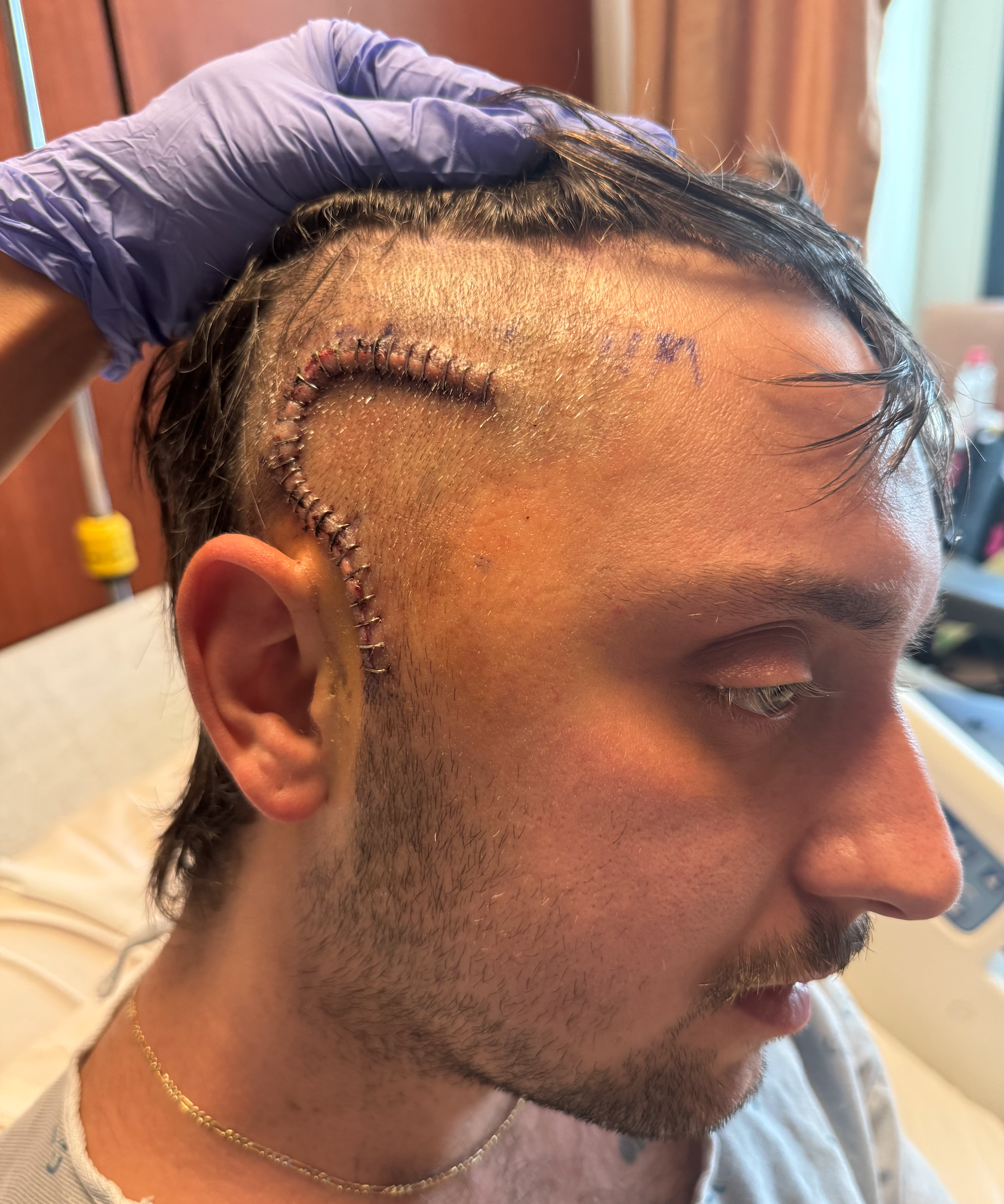 Nick with a scar from surgery